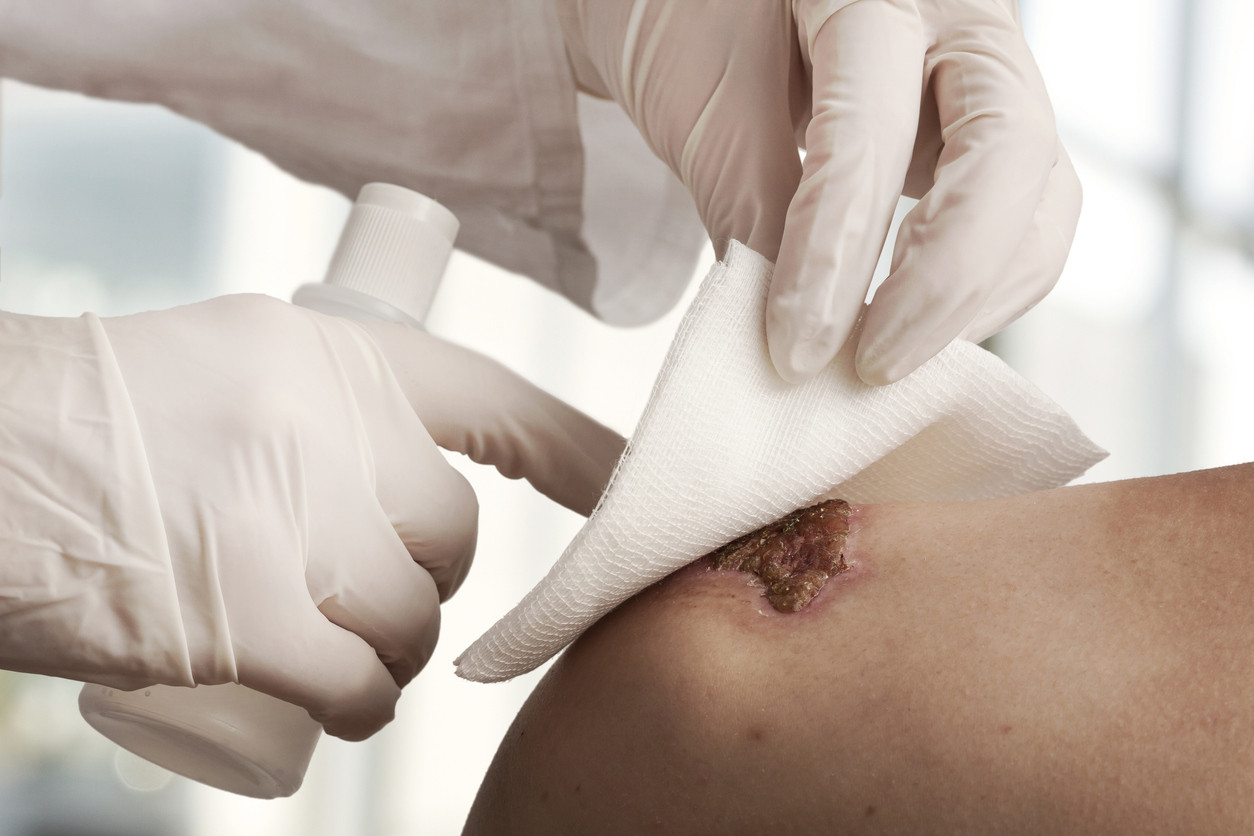 Jak správně ošetřit ránu a podpořit hojení: rady pro domácí péči i prevenci komplikací - post cover